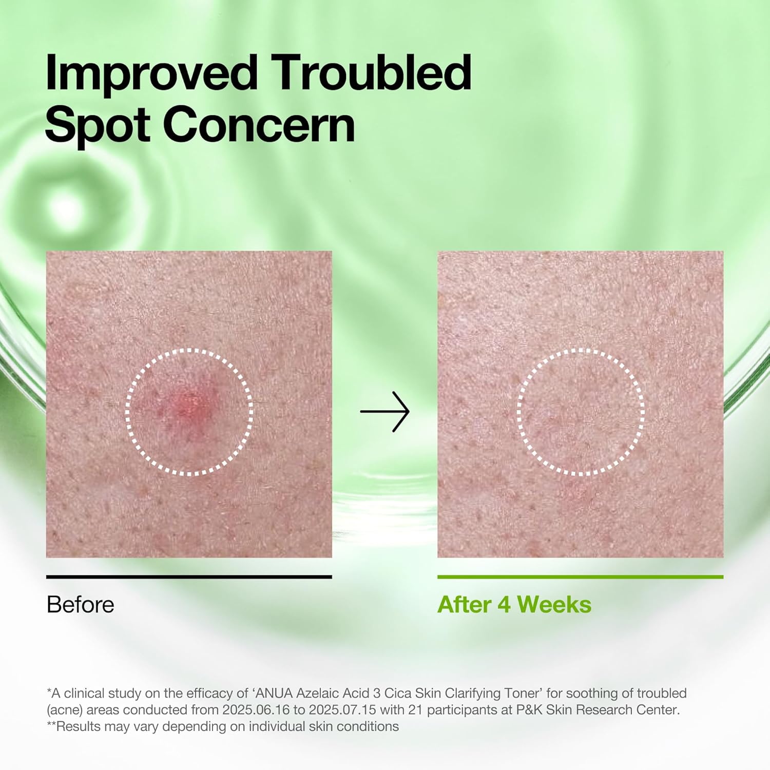 Anua Azelaic Acid 3 Cica Skin Clarifying Toner  250ml