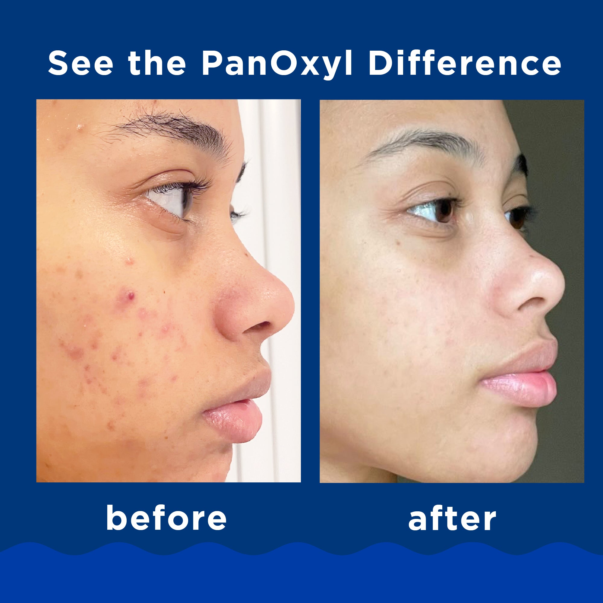 PanOxyl Acne Foaming Wash 10% 5.5oz
